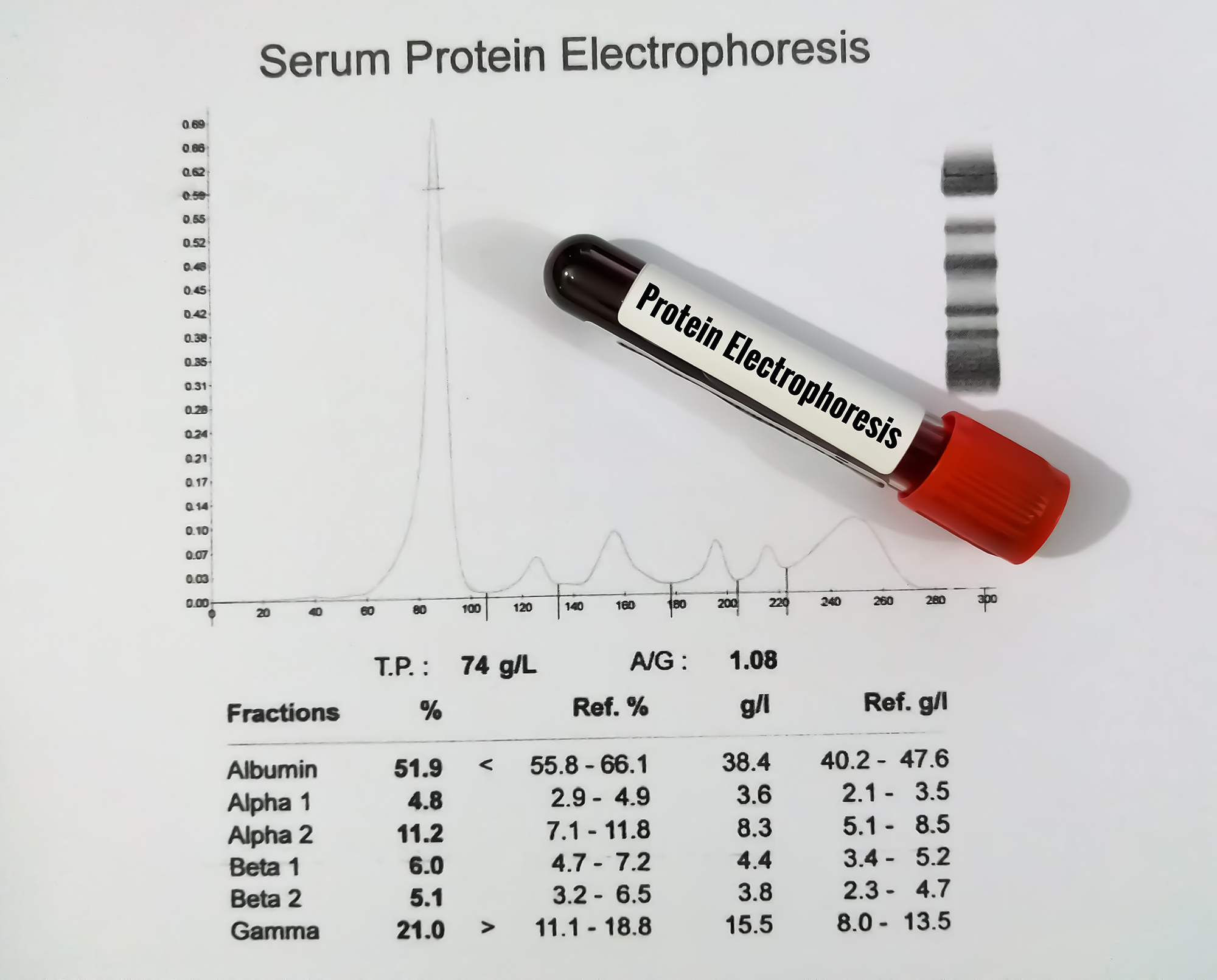 blood-sample-patient-s-report-isolated-protein-electrophoresis-test-close-up